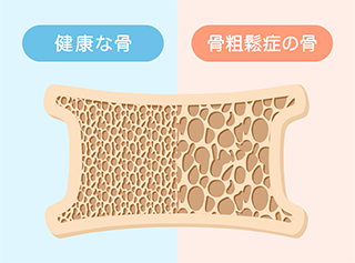 骨粗鬆症外来について